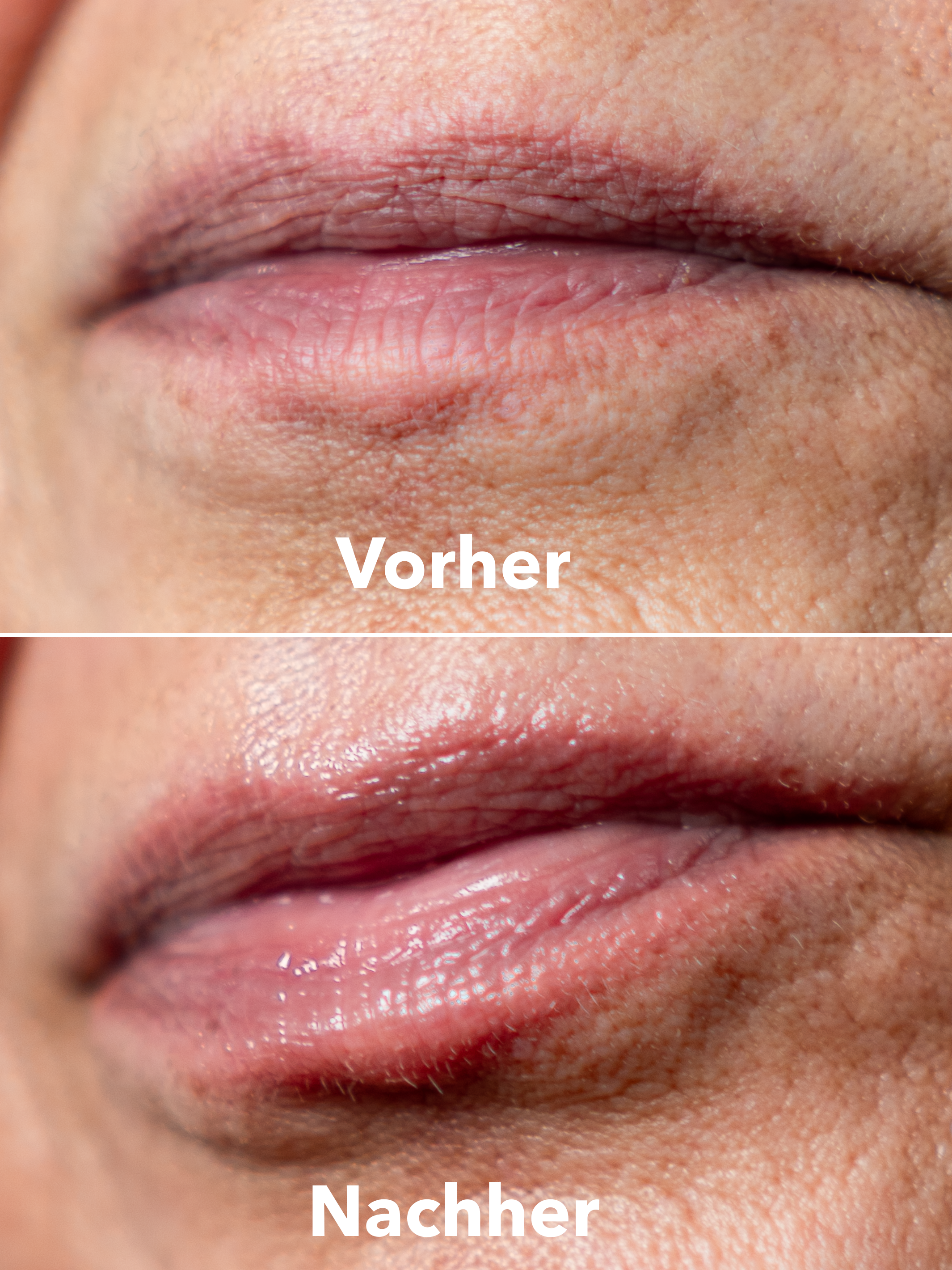 XTREME Lip Recovery