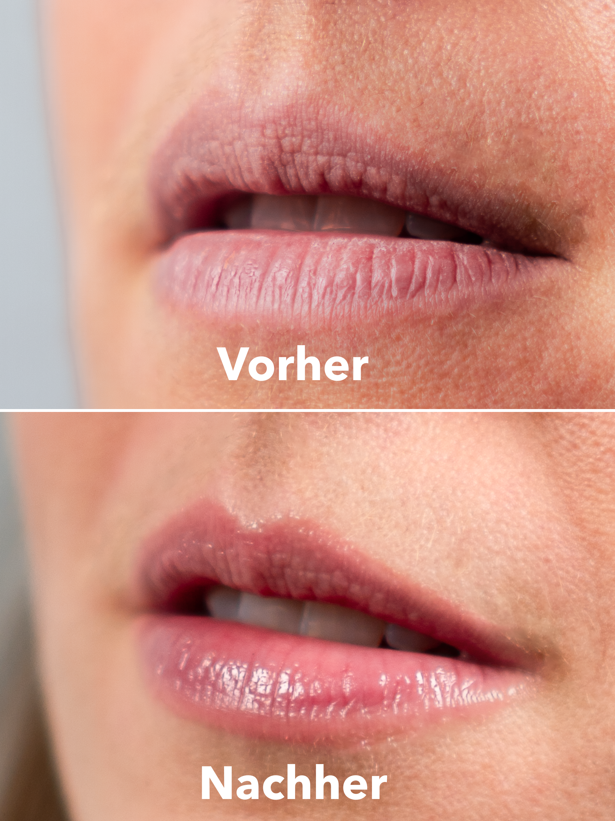 XTREME Lip Recovery